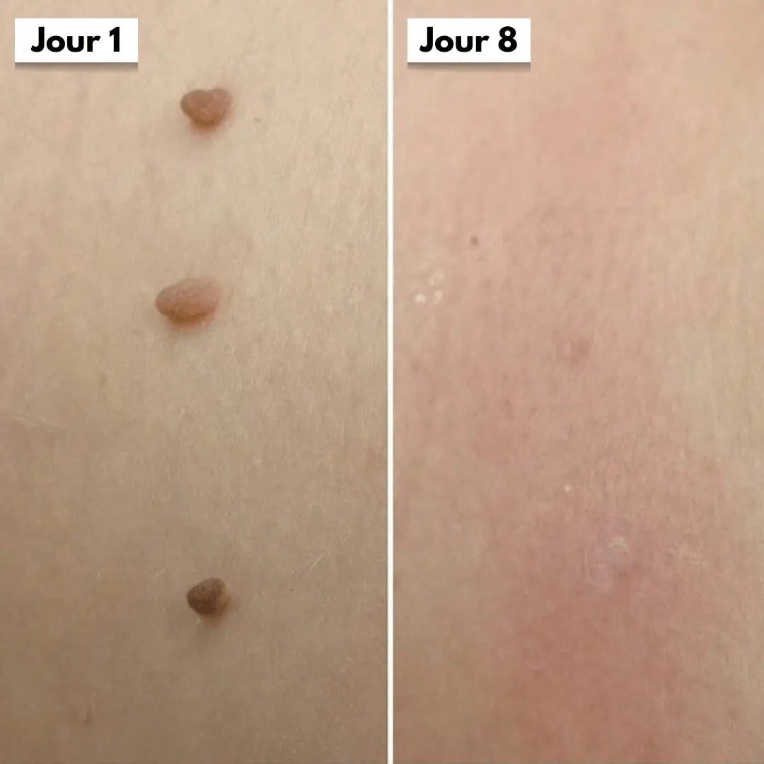 DermaSkin Pro™ - Adieu les acrochordons