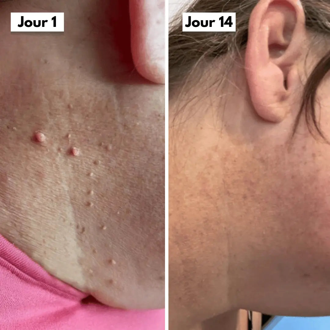 DermaSkin Pro™ - Adieu les acrochordons