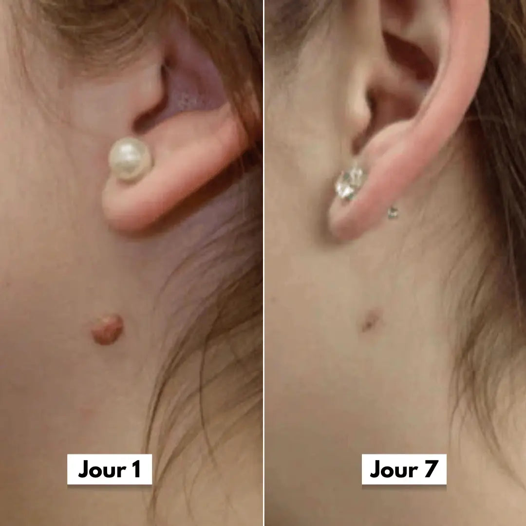 DermaSkin Pro™ - Adieu les acrochordons