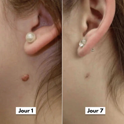 DermaSkin Pro™ - Adieu les acrochordons